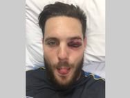 Nasty Blow On Left Eye Mitchell Mcclenaghan As Ball Smashes Through Grille