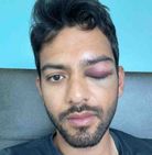 Unmukt Chand Suffers Eye Injury In Usa While Playing Minor League Cricket