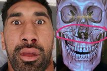 ರಗ್ಬಿ ಆಟಗಾರ ಸೋಲಿಯೊಲಾ ಮುಖದ ಒಳಗಿದೆ ಬರೋಬ್ಬರಿ 20 ಸ್ಕ್ರೂಗಳು!