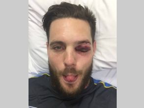 Nasty blow on left eye for Mitchell McClenaghan as ball smashes through grille