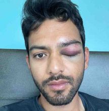 Unmukt Chand suffers eye injury in USA while playing minor league cricket