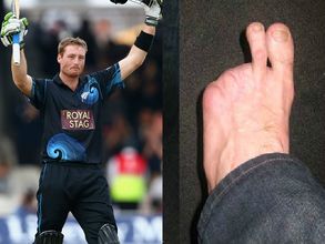 డబుల్ సెంచరీ వీరుడు మార్టిన్ గుప్తిల్ ఎడమ కాలికి రెండు వేళ్లే...!