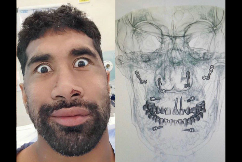 Sia Soliola suffers multiple facial fractures, has 20 screws inserted into face