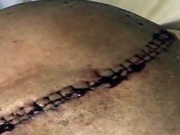 തലമുറിച്ചു ശസ്ത്രക്രിയ