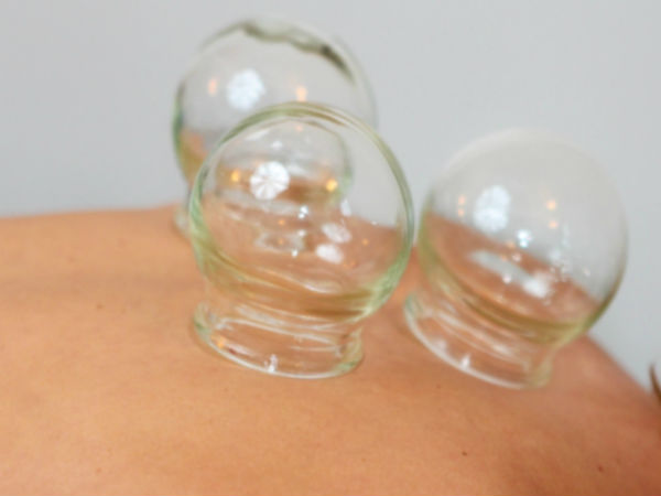 சீனா கப்பிங் சிகிச்சை