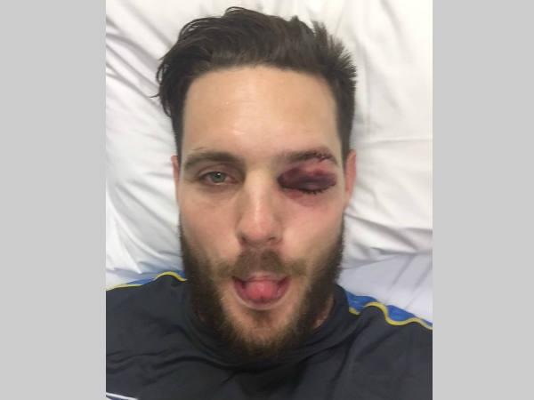 Nasty blow on left eye for Mitchell McClenaghan as ball smashes through grille Nasty blow on left eye for Mitchell McClenaghan as ball smashes through grille