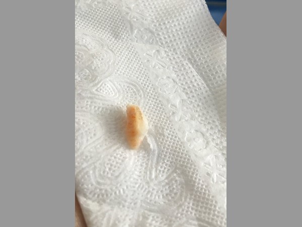 విరిగిన మోకాలి ఎముక