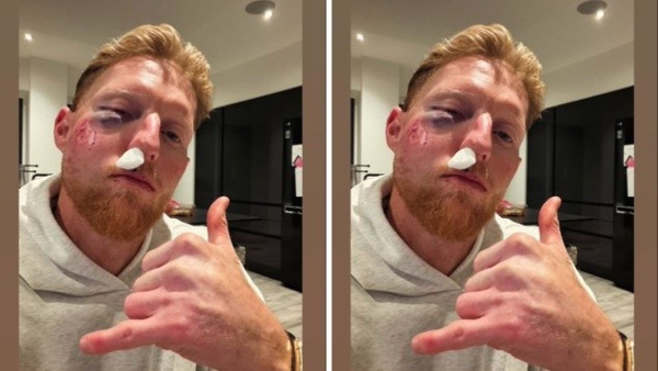 Ben Stokes Suffers Severe Facial Injury After Being Struck by Ball England Star Hospitalised